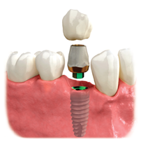 implants-dentaires3.jpg